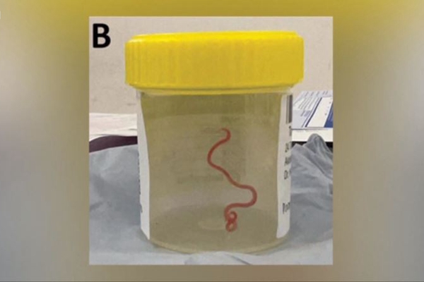 世界首次：人脑中发现活蠕虫，长达8厘米！